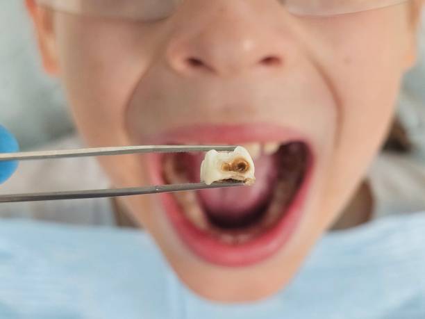 Best Emergency Tooth Extraction in South Deerfield, MA